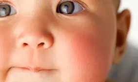 علت گل انداختن و سرخ شدن گونه ها چیست؟