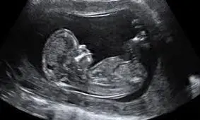 هشدار دوباره پدر علم ژنتیک ایران درخصوص اهمیت غربالگری جنین