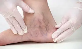 علائم وجود واریس چیست؟