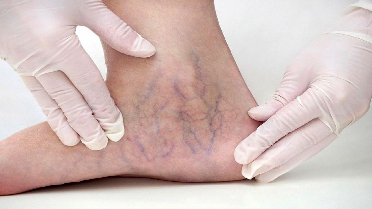 علائم وجود واریس چیست؟
