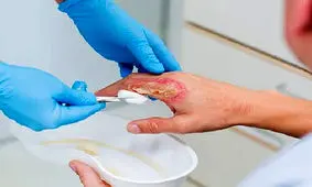 تأثیر پماد سنجد تلخ بر مدت زمان ترمیم زخم سوختگی