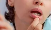 زخم های دردناک دهان از کجا می‌آیند؟