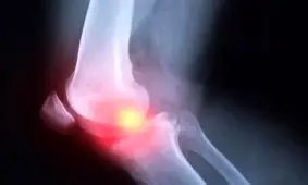 آرتروز دیگر فقط بیماری سالمندان نیست