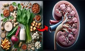 مواد غذایی و خوردنی هایی که سنگ کلیه تولید می کنند