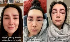 واکنش آلرژیک یک زن به لمینت ابرو