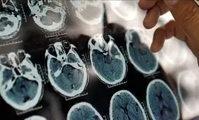 هشدار درباره شروع یک بیماری سخت از ۴۰ سالگی