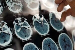 هشدار درباره شروع یک بیماری سخت از ۴۰ سالگی