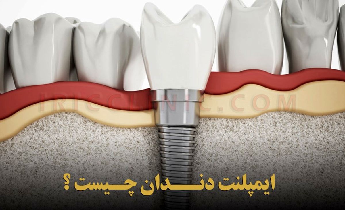هزینه ایمپلنت دندان در سال 1402 چقدر است ؟