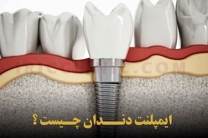 هزینه ایمپلنت دندان در سال 1402 چقدر است ؟ 