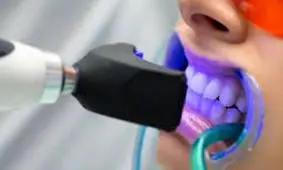 حساسیت موقت؛ شایع ترین عارضه در هنگام سفید کردن دندان ها