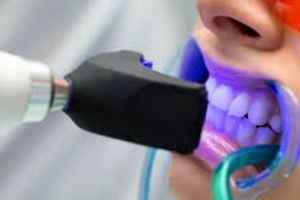 حساسیت موقت؛ شایع ترین عارضه در هنگام سفید کردن دندان ها