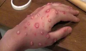 تکذیب شایعه بستری بیمار مبتلا به آبله میمونی