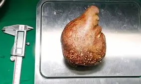 بزرگترین سنگ کلیه جهان به وزن ۸۰۰ گرم