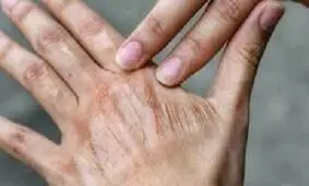 تاثیر خاموش آلودگی هوا بر سلامت و پیری پوست