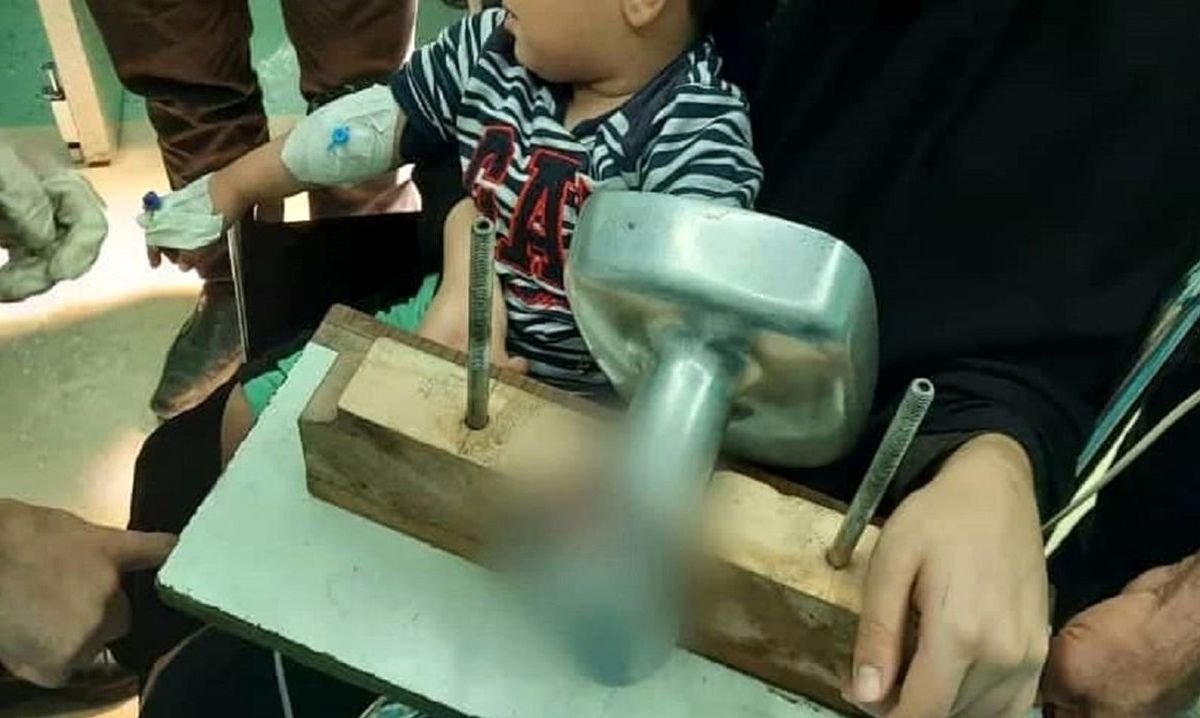 چرخ گوشت انگشت دست پسر 2 ساله را چرخ کرد