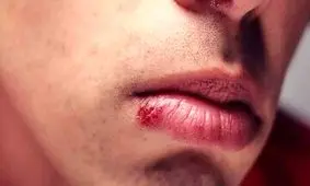 علت اینکه به صورت مداوم تبخال می‌زنیم چیست؟