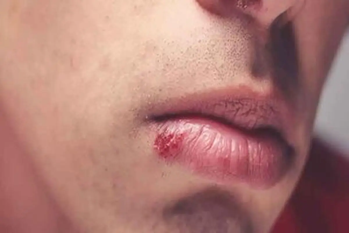 علت اینکه به صورت مداوم تبخال می‌زنیم چیست؟