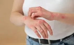 این ملحفه‌ ها باعث اگزما در پوست می‌شوند

