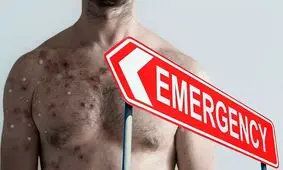 شیوع «آبله میمون» وضعیت اضطراری جهانی اعلام شد