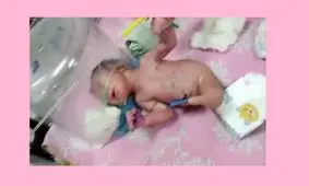 تولد یک نوزاد عجیب‌ الخلقه که به جای پا، دُم‌ دارد / عکس 