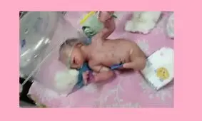 تولد یک نوزاد عجیب‌ الخلقه که به جای پا، دُم‌ دارد / عکس 