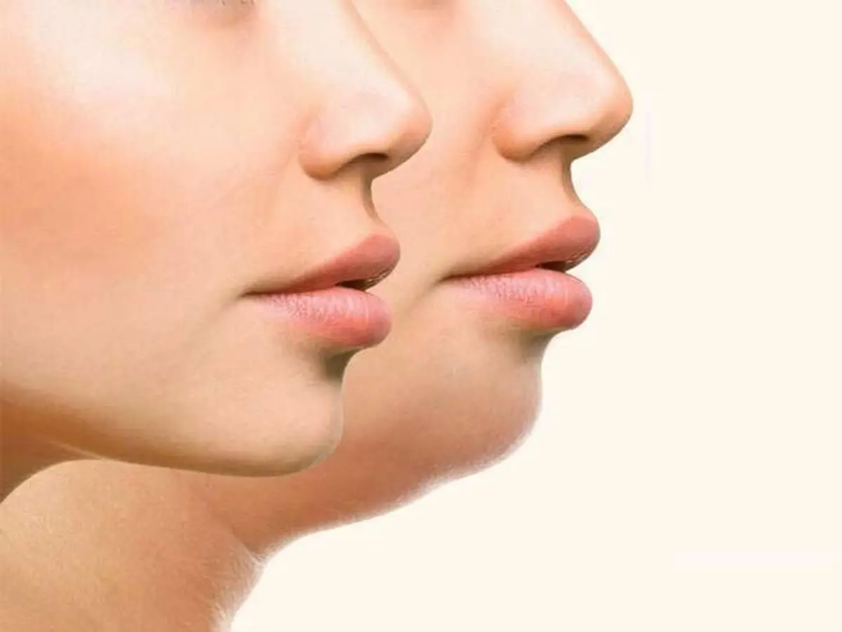 راه‌هایی برای چاق‌شدن صورت