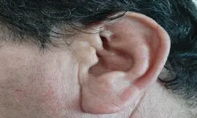 چند توصیه برای باز کردن گرفتگی گوش


