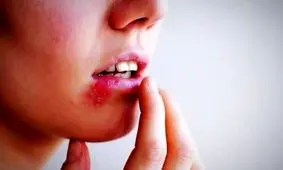 بروز تبخال قدمتی ۴۰۰۰ ساله دارد