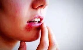 بروز تبخال قدمتی ۴۰۰۰ ساله دارد