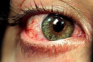 قرمز شدن چشم نشانه چیست؟