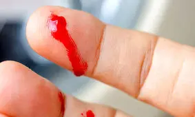 خونریزی هایی که نشانه هموفیلی هستند