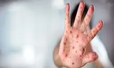 ایران در مرحله حذف سرخک و سرخجه