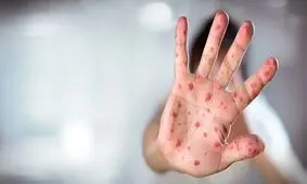 ایران در مرحله حذف سرخک و سرخجه