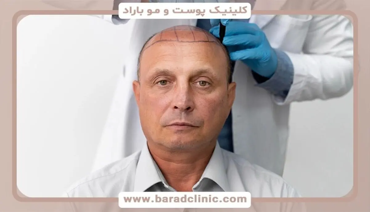 جراحی کاشت مو؛ بررسی روش تکثیری و شرایط پرداخت قسطی