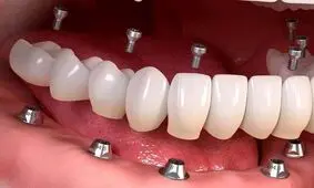 ایمپلنت در کرج
