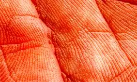 بررسی ارتباط میان التهاب و خطر ابتلا به سرطان پوست