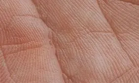 بررسی ارتباط میان التهاب و خطر ابتلا به سرطان پوست