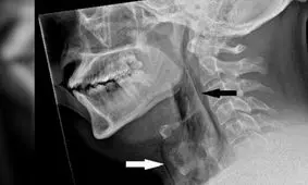 ثبت یک مورد عجیب سوراخ شدن «نای» در اثر نگه داشتن عطسه

