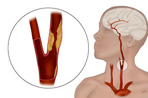 بیماری سرخرگ کاروتید: علل، علائم و درمان