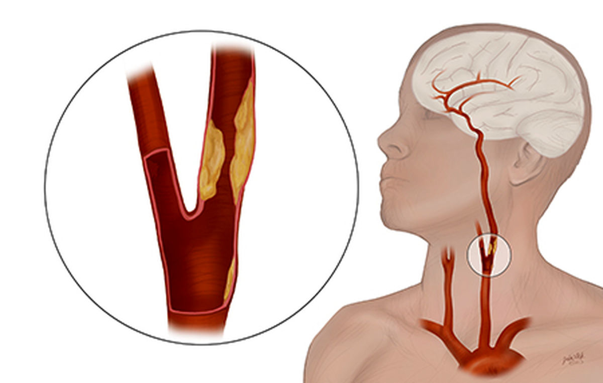 بیماری سرخرگ کاروتید: علل، علائم و درمان