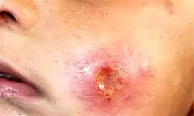 انتقال محلی سالک در ۱۸ استان کشور 