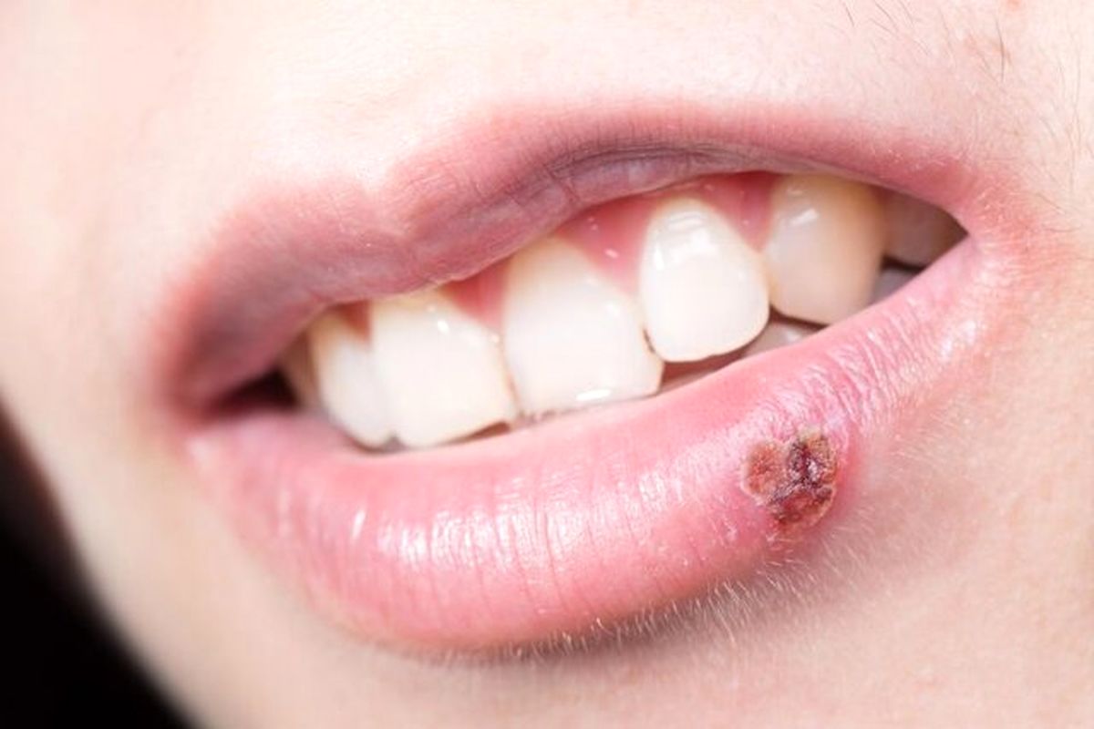 خطر انتقال ویروس تبخال را چگونه کاهش دهیم؟