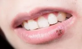 خطر انتقال ویروس تبخال را چگونه کاهش دهیم؟