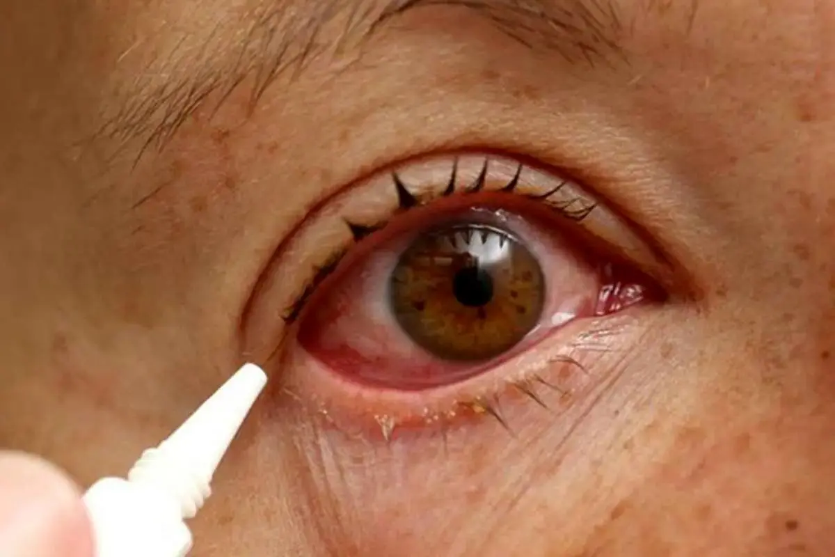 در زمان تروما یا ضربه به چشم در اثر انفجار چه باید کرد؟/ هشدار: به آسیب‌دیدگان چشمی، آب یا غذا ندهید/ خوددرمانی با قطره و مالش چشم، ممنوع!