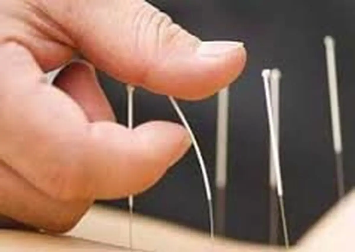 طب سوزنی می تواند به پیشگیری از دیابت کمک کند؟