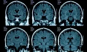 پیری زودرس مغز نوجوانان در پی قرنطینه کرونا