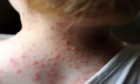 زنگ خطر شیوع سرخک در یزد به صدا درآمد