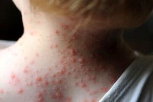 زنگ خطر شیوع سرخک در یزد به صدا درآمد