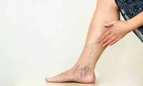 چرا واریس خطرناک است؟