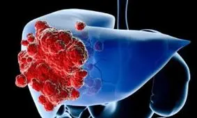 سیستم بافت‌برداری جدید برای تشخیص آسان‌تر سرطان کبد

